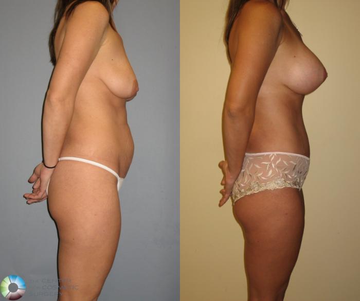 Before & After Tummy Tuck Case 228 View #3 View in Golden, CO