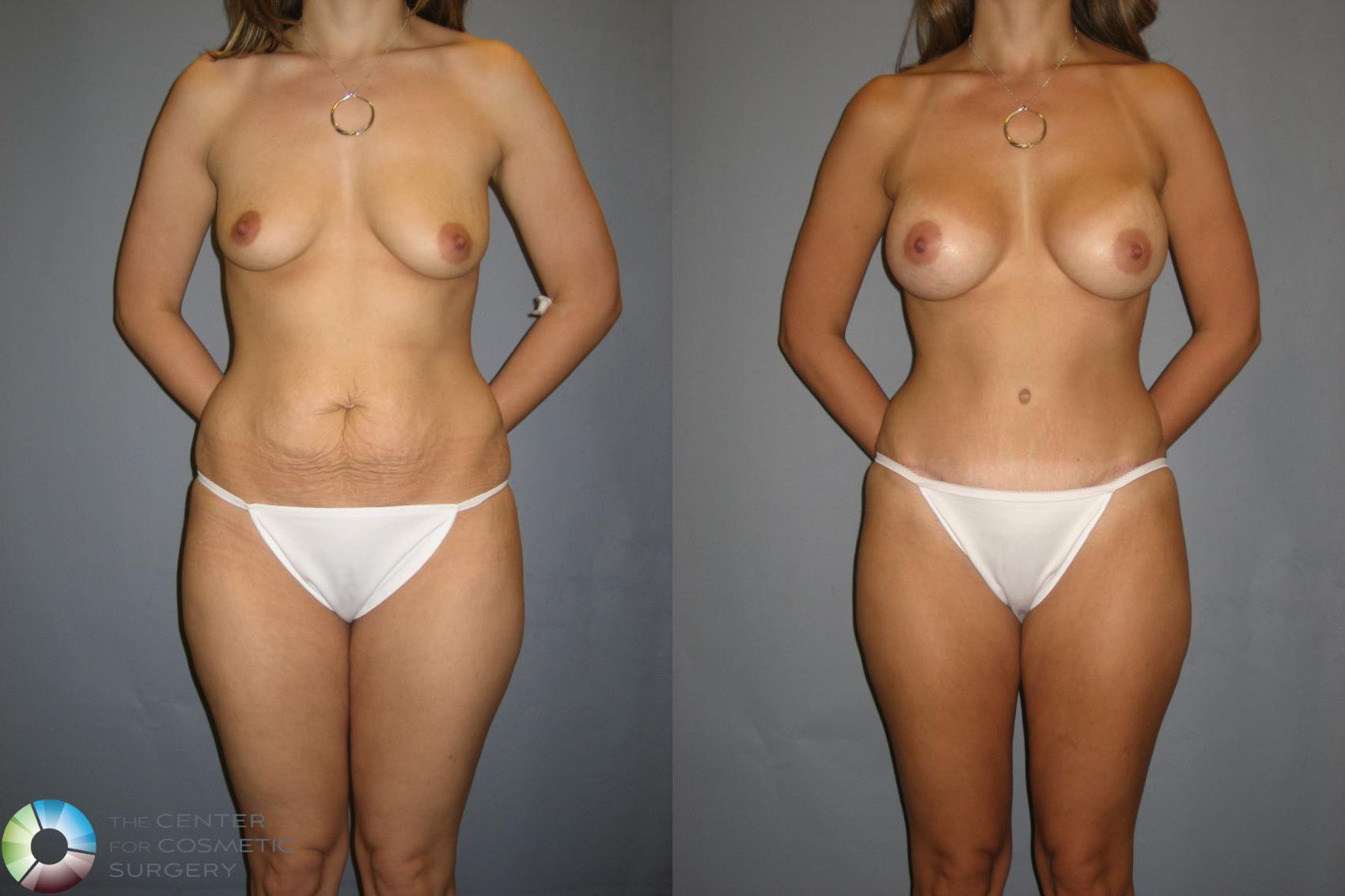 Before & After Breast Augmentation Case 234 View #1 View in Golden, CO