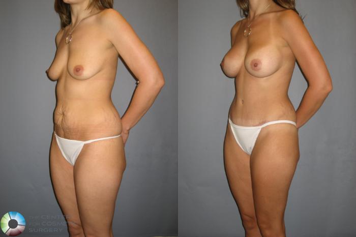 Before & After Breast Augmentation Case 234 View #2 View in Golden, CO