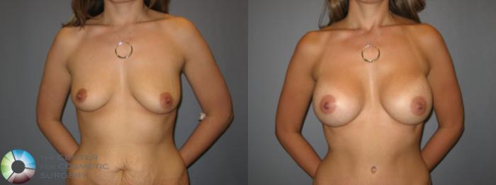 Before & After Breast Augmentation Case 234 View #4 View in Golden, CO