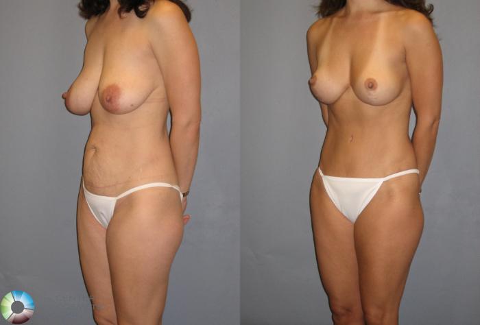 Before & After Breast Lift without Implants Case 239 View #1 View in Golden, CO