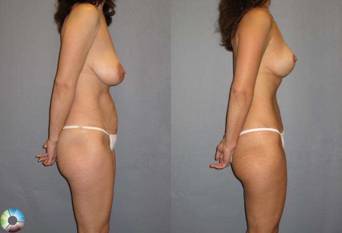 Before & After Breast Lift without Implants Case 239 View #2 View in Golden, CO