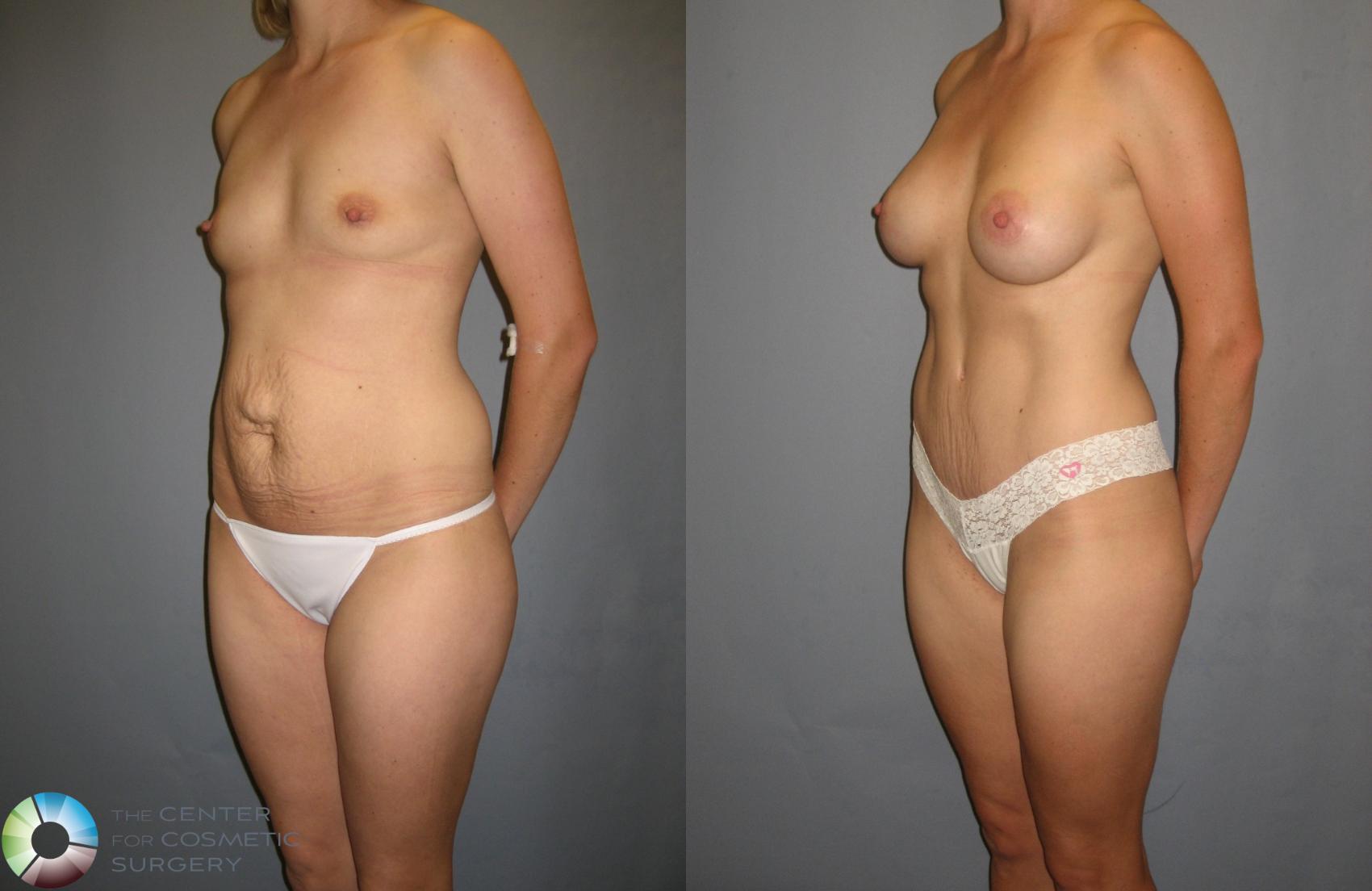 Before & After Tummy Tuck Case 240 View #1 in Denver and Colorado Springs, CO