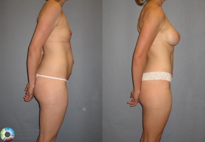 Before & After Breast Augmentation Case 240 View #2 View in Golden, CO