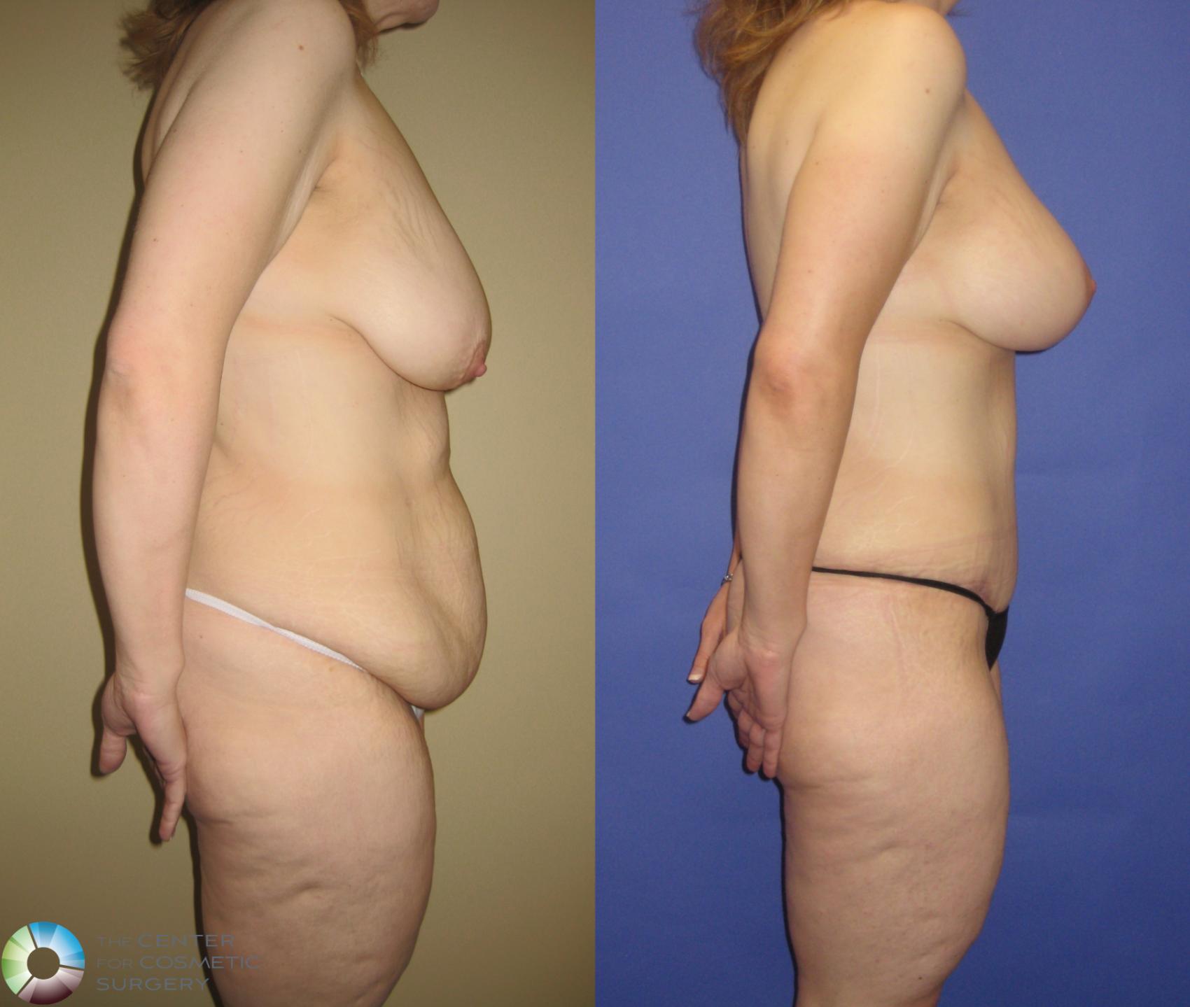 Before & After Mommy Makeover Case 249 View #2 in Denver and Colorado Springs, CO