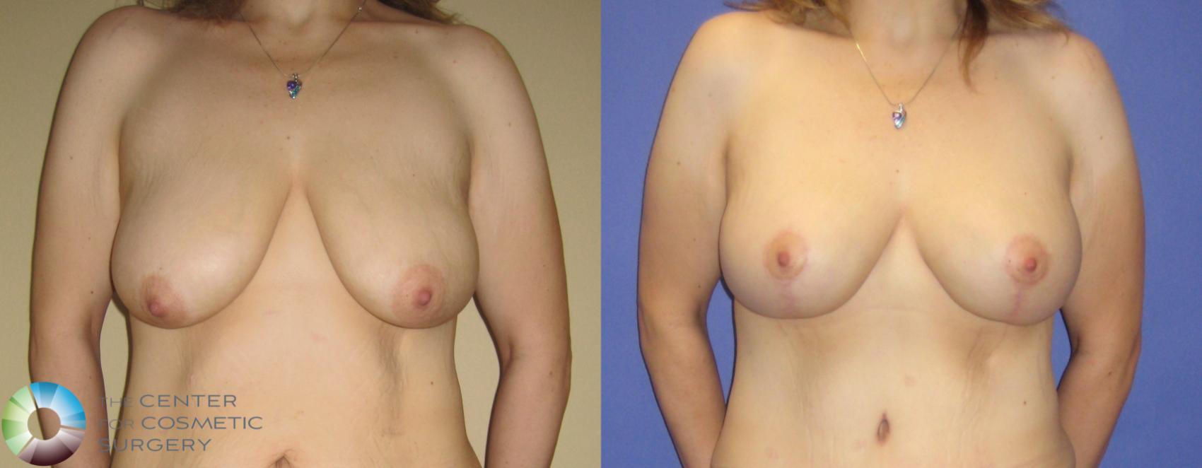 Before & After Mommy Makeover Case 249 View #5 in Denver and Colorado Springs, CO