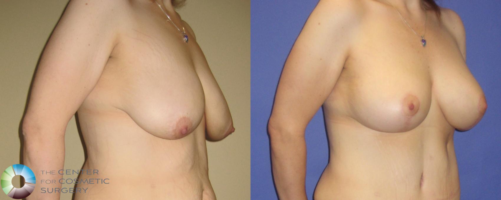 Before & After Mommy Makeover Case 249 View #6 in Denver and Colorado Springs, CO