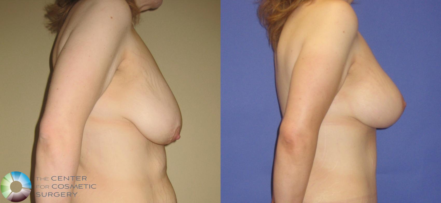 Before & After Mommy Makeover Case 249 View #7 in Denver and Colorado Springs, CO