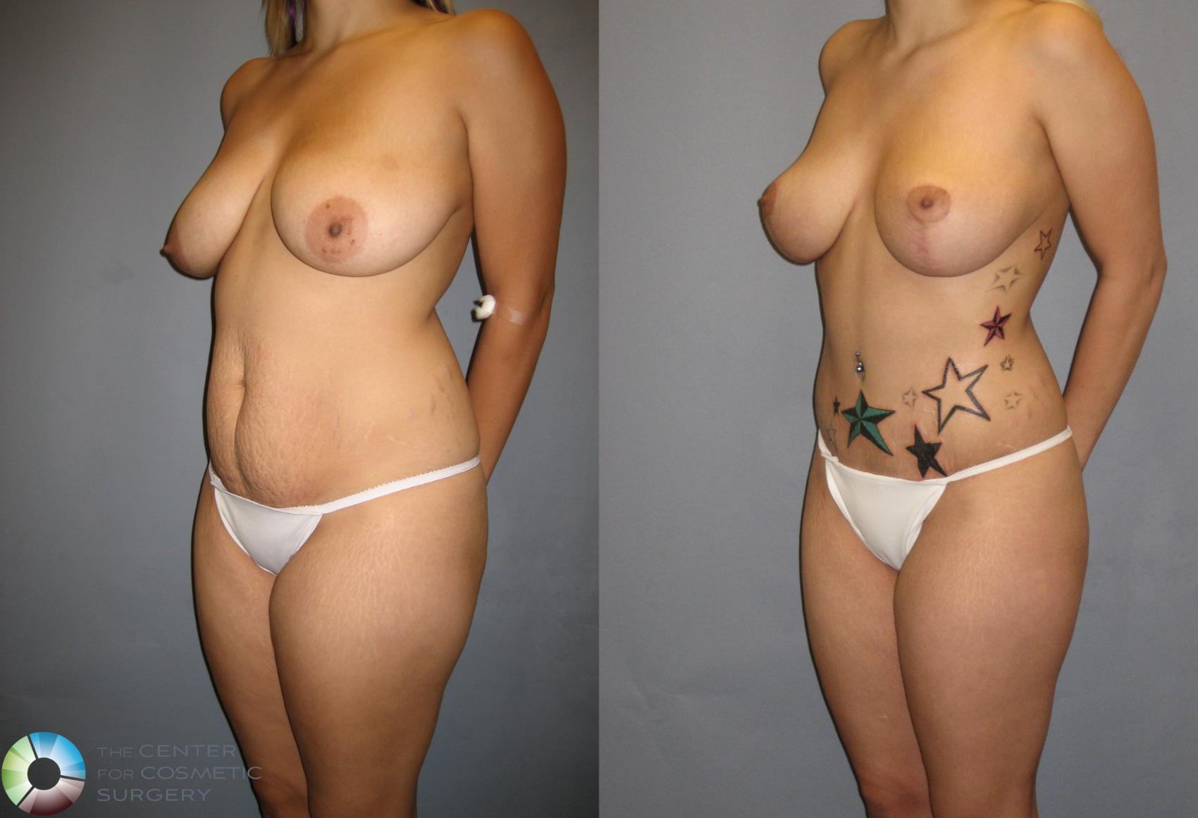 Before & After Breast Lift Case 260 View #1 in Denver and Colorado Springs, CO