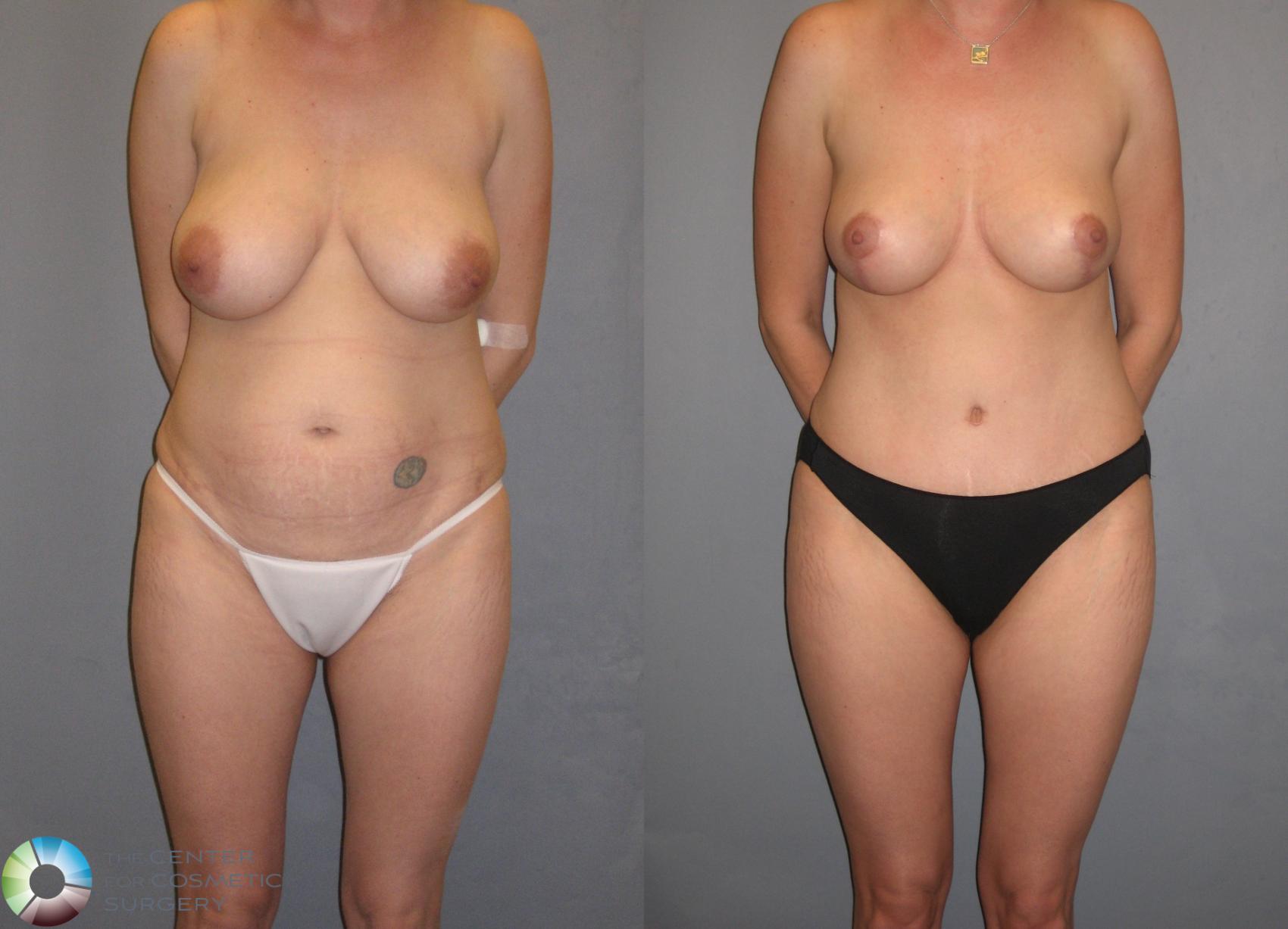 Before & After Breast Lift without Implants Case 262 View #1 in Denver and Colorado Springs, CO