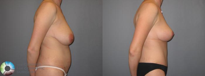 Before & After Breast Lift without Implants Case 262 View #2 in Denver and Colorado Springs, CO
