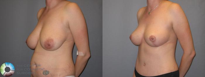 Before & After Breast Lift without Implants Case 262 View #3 in Denver and Colorado Springs, CO