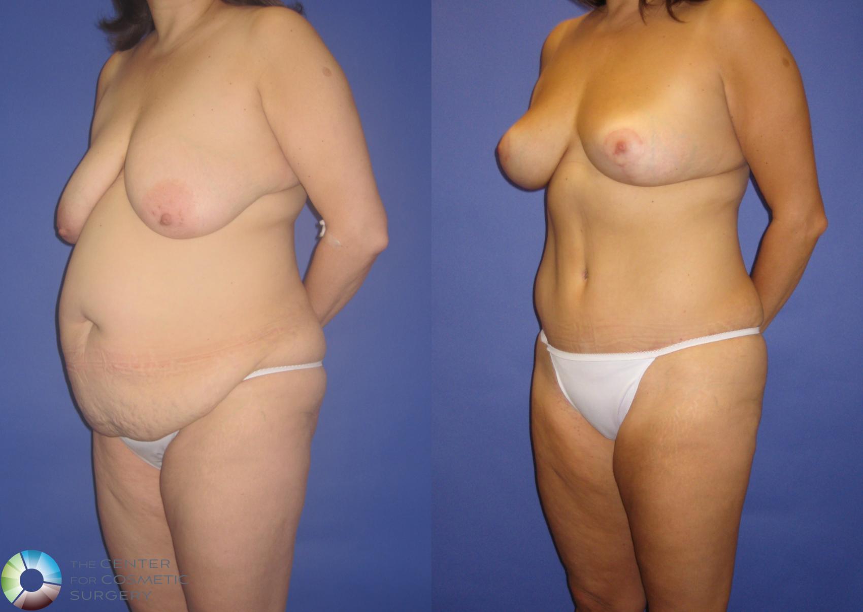 Before & After Mommy Makeover Case 269 View #2 in Denver and Colorado Springs, CO