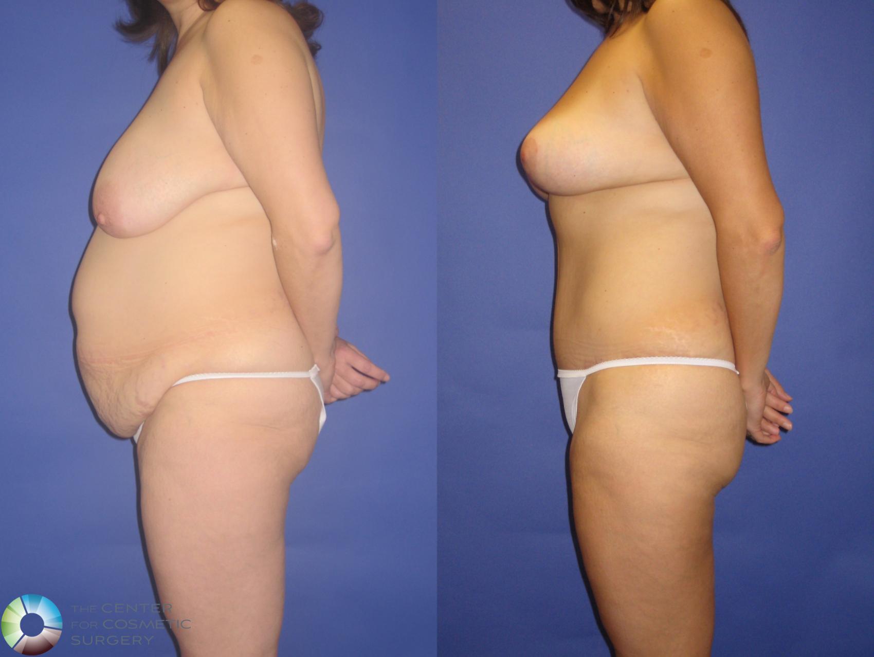 Before & After Mommy Makeover Case 269 View #3 in Denver and Colorado Springs, CO