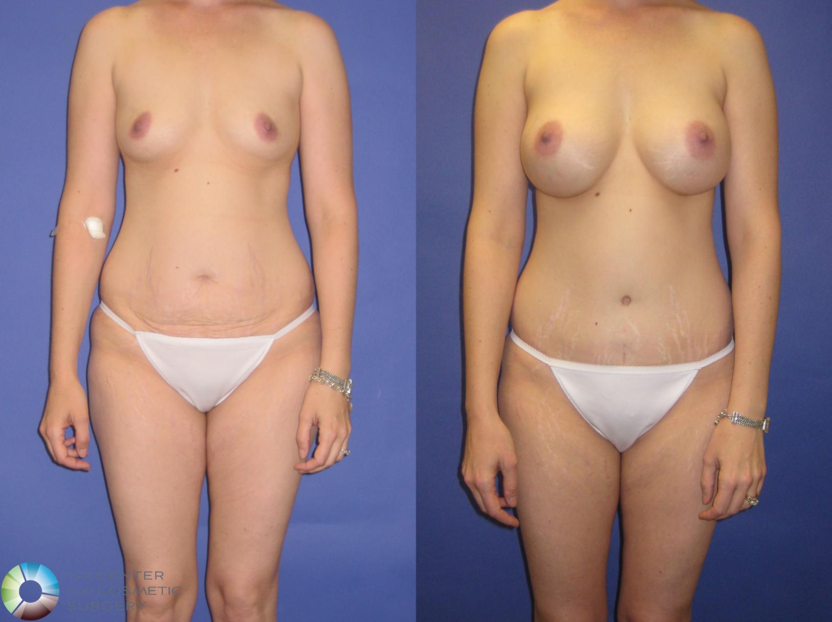 Before & After Breast Augmentation Case 270 View #1 in Denver and Colorado Springs, CO