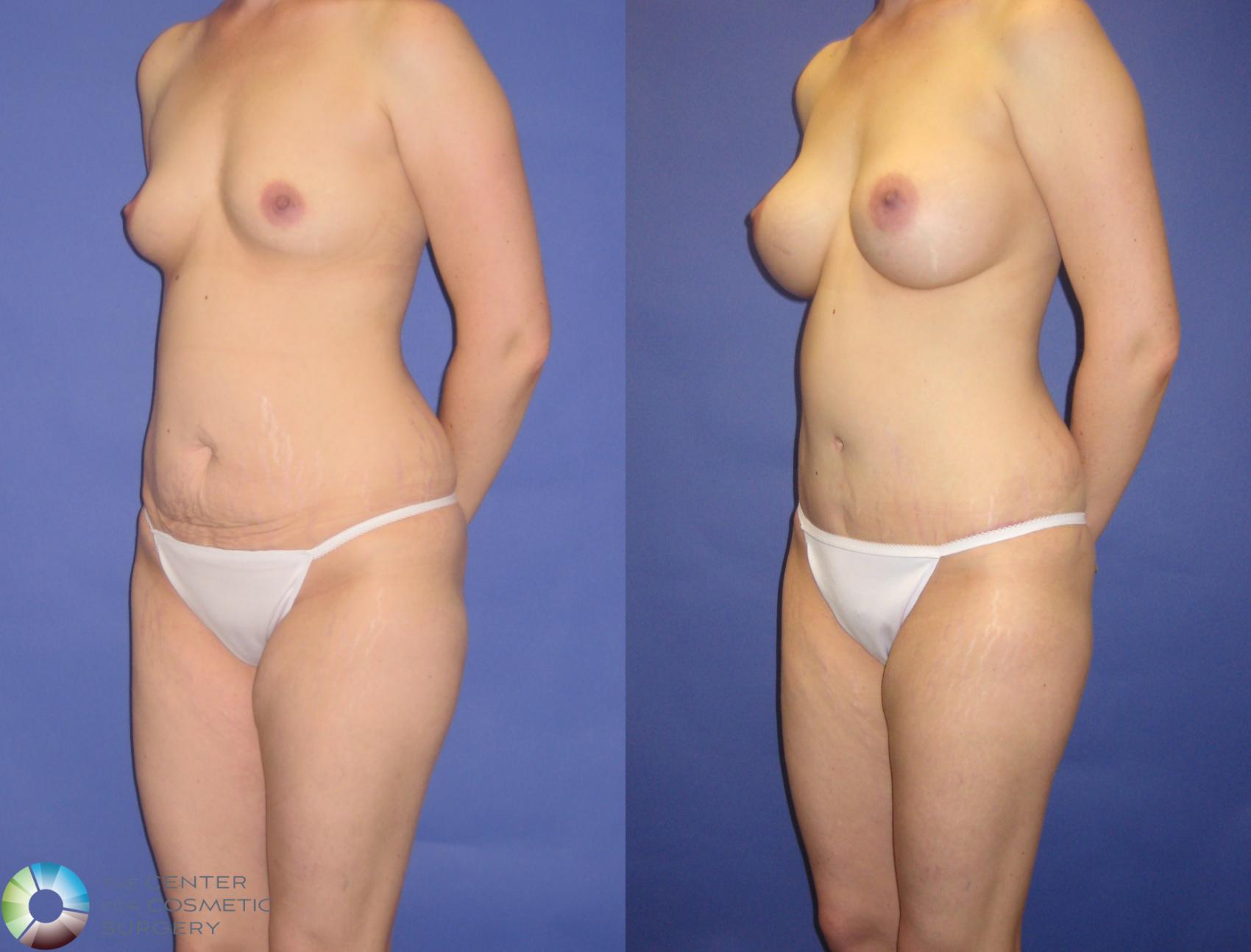 Before & After Breast Augmentation Case 270 View #2 View in Denver & Golden, CO