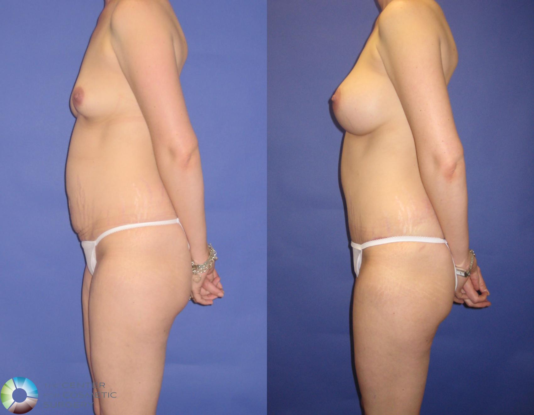 Before & After Breast Augmentation Case 270 View #3 View in Denver & Golden, CO