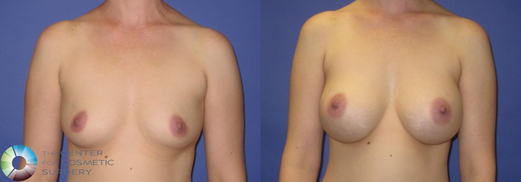 Before & After Breast Augmentation Case 270 View #6 View in Denver & Golden, CO