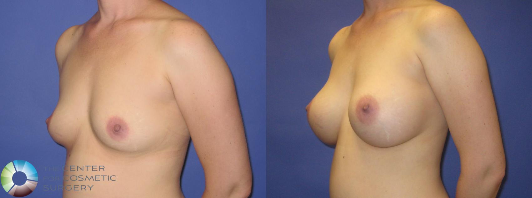 Before & After Breast Augmentation Case 270 View #7 View in Denver & Golden, CO