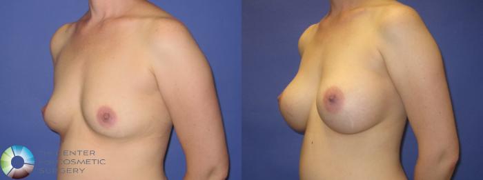 Before & After Breast Augmentation Case 270 View #7 View in Golden, CO
