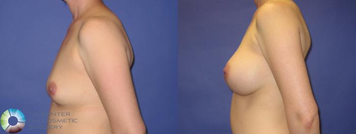 Before & After Breast Augmentation Case 270 View #8 View in Golden, CO