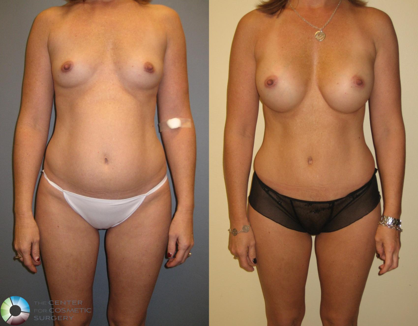 Before & After Breast Augmentation Case 276 View #1 in Denver and Colorado Springs, CO