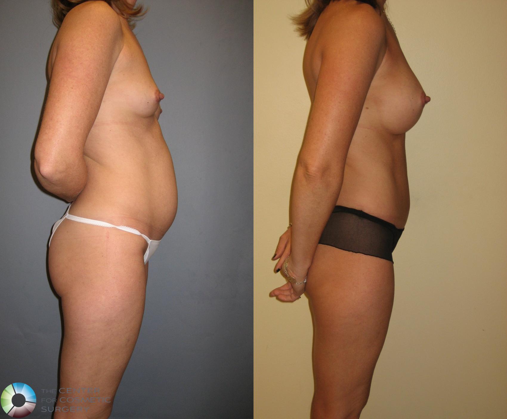 Before & After Mommy Makeover Case 276 View #2 in Denver and Colorado Springs, CO