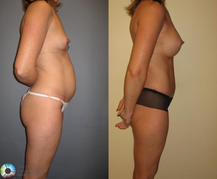 Before & After Tummy Tuck Case 276 View #2 View in Golden, CO
