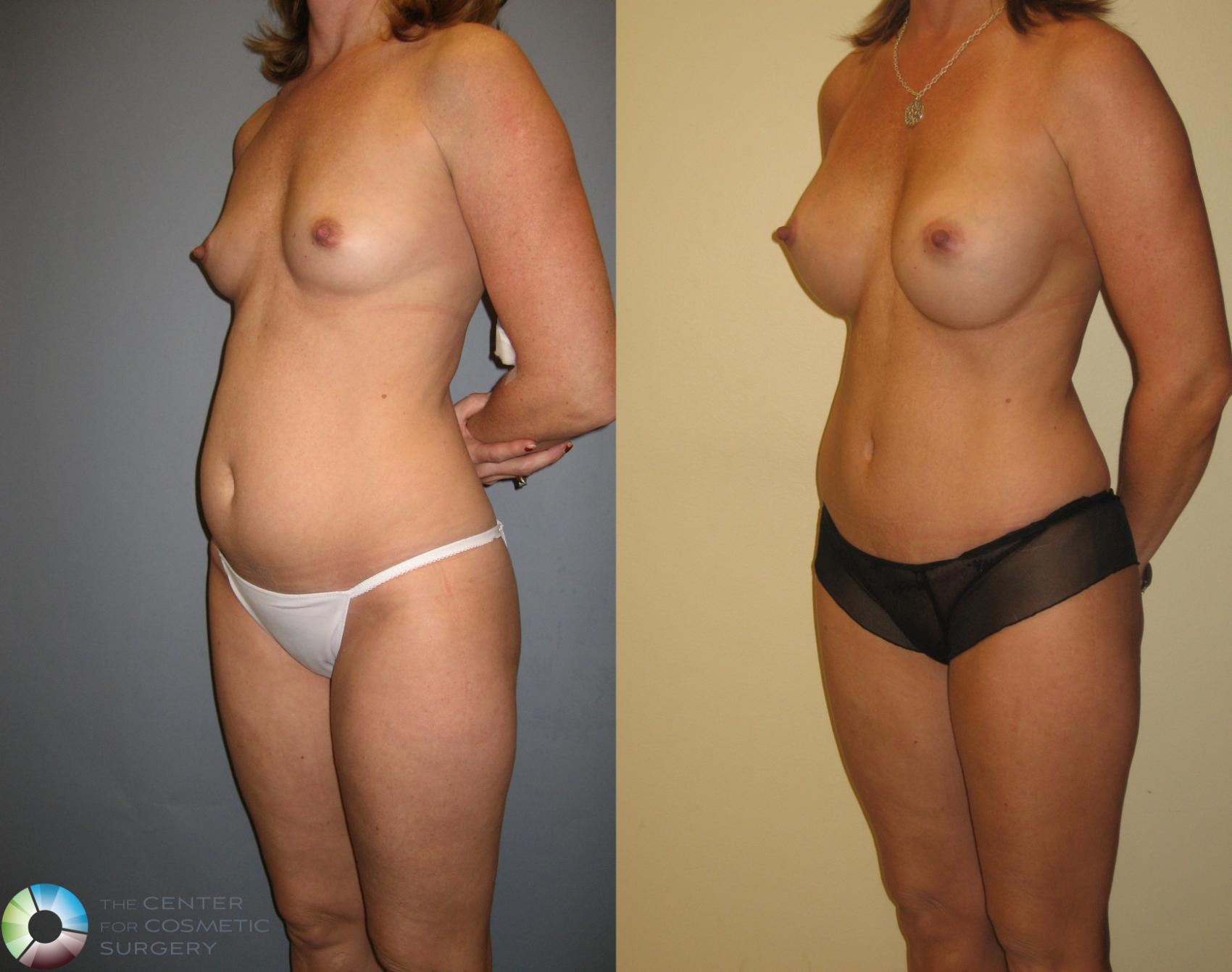 Before & After Mommy Makeover Case 276 View #3 in Denver and Colorado Springs, CO