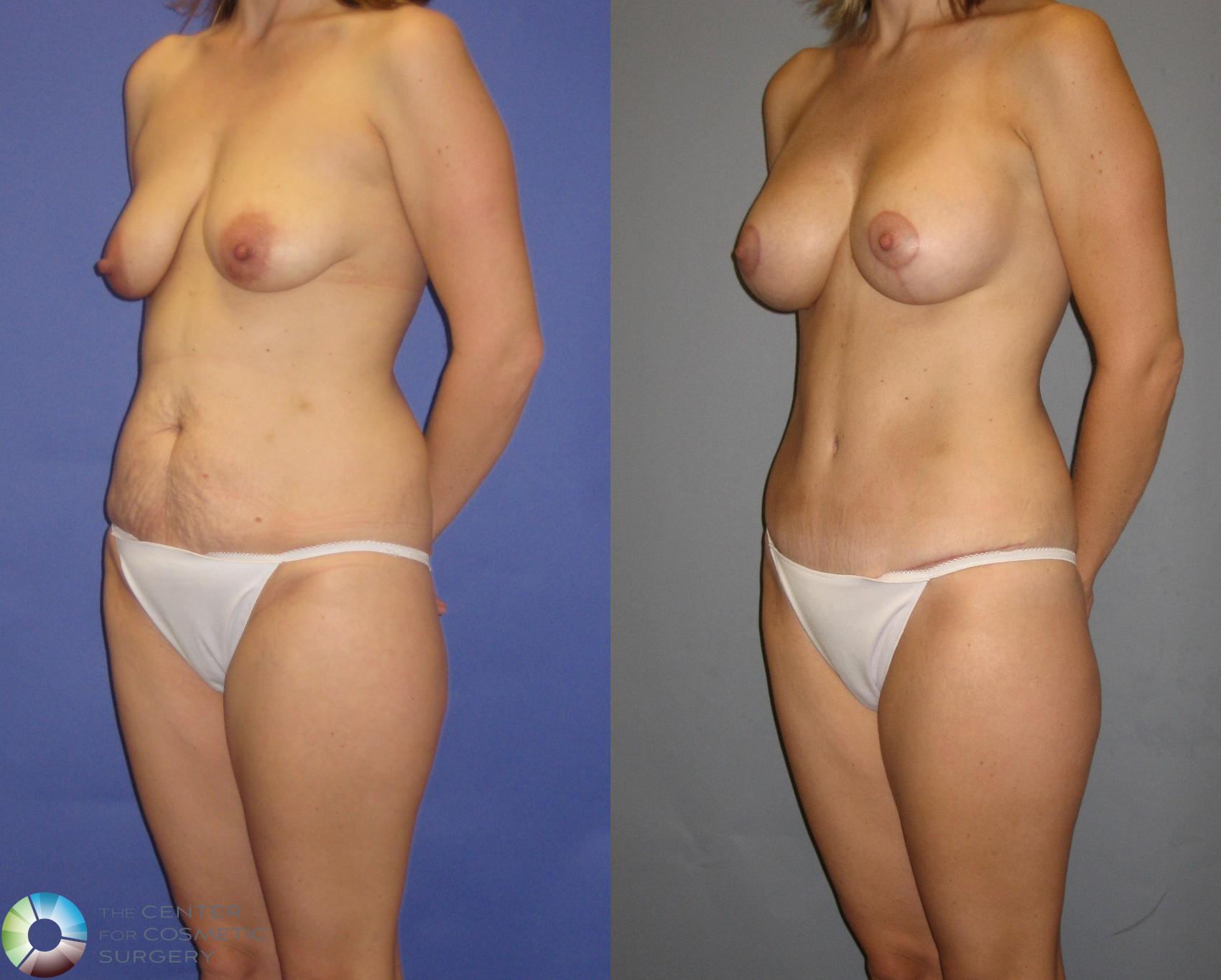 Before & After Mommy Makeover Case 299 View #2 in Denver and Colorado Springs, CO