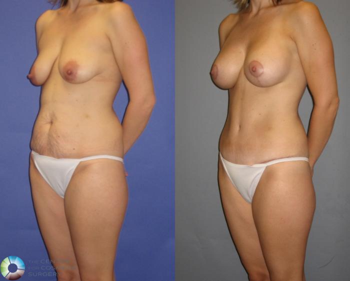 Before & After Tummy Tuck Case 299 View #2 View in Golden, CO