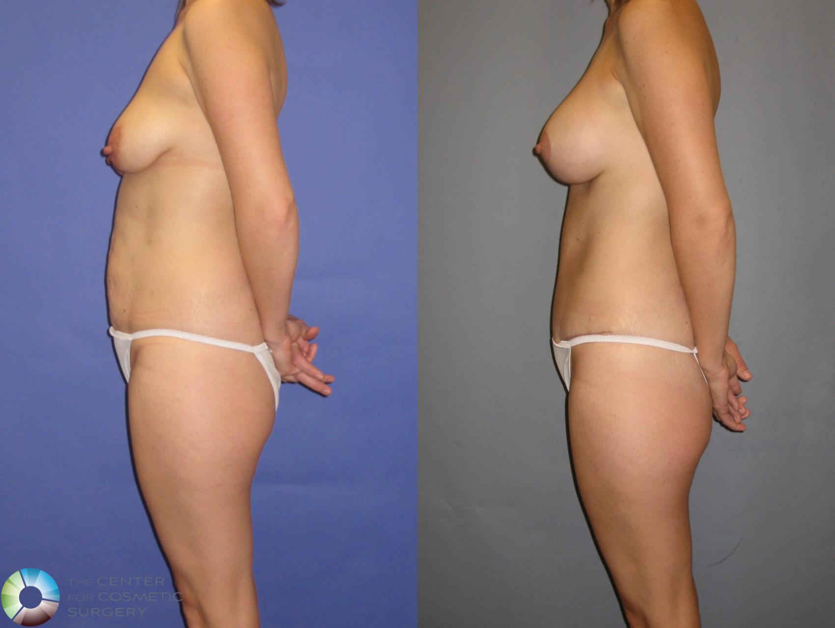 Before & After Mommy Makeover Case 299 View #3 in Denver and Colorado Springs, CO