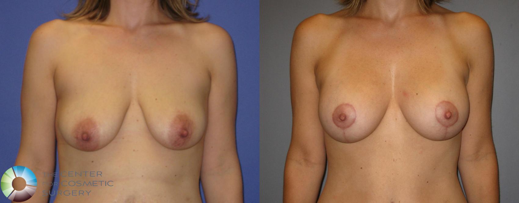 Before & After Mommy Makeover Case 299 View #4 in Denver and Colorado Springs, CO