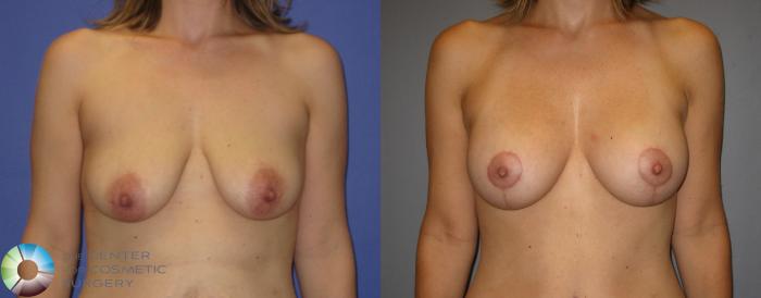 Before & After Breast Augmentation Case 299 View #4 View in Golden, CO