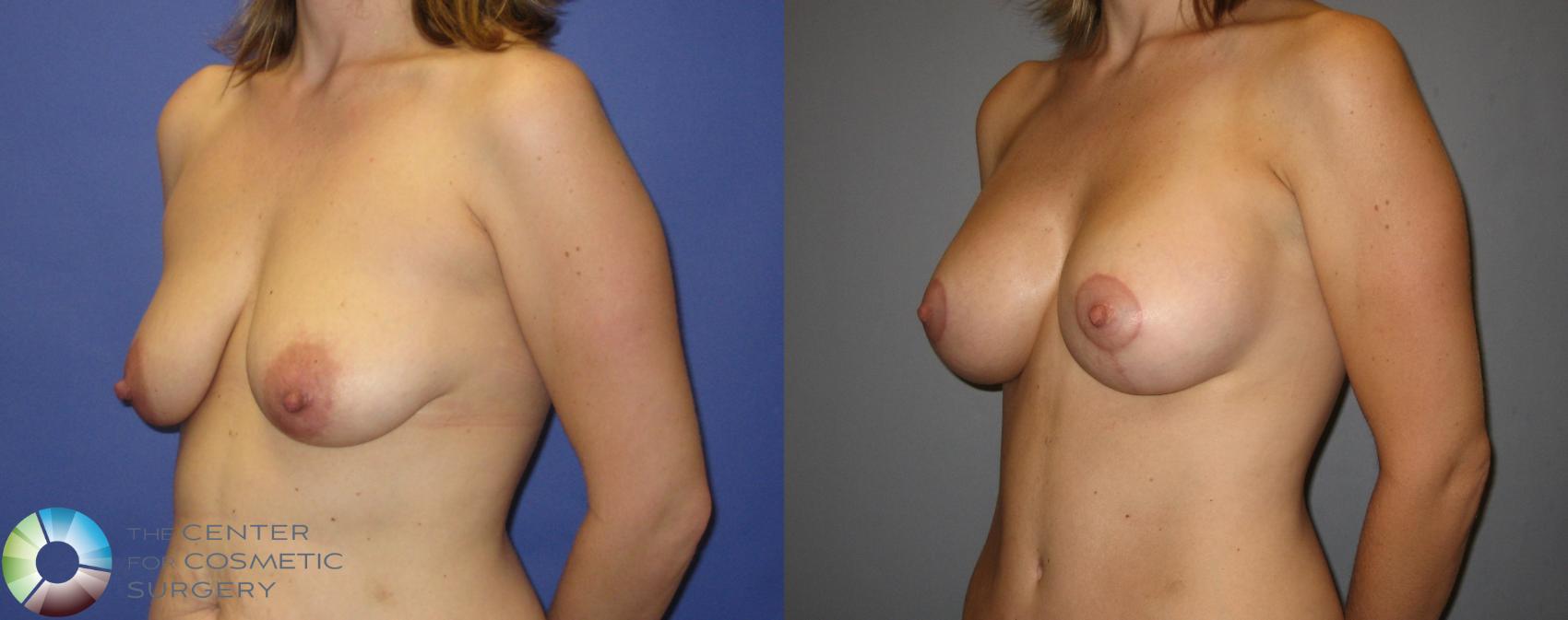 Before & After Mommy Makeover Case 299 View #5 in Denver and Colorado Springs, CO
