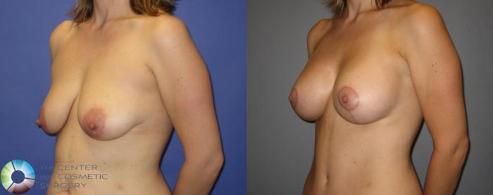 Before & After Tummy Tuck Case 299 View #5 View in Golden, CO