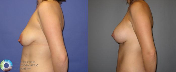 Before & After Breast Augmentation Case 299 View #6 View in Golden, CO