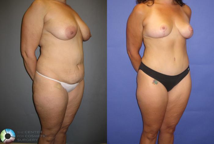 Before & After Breast Reduction Case 335 View #2 in Denver, CO