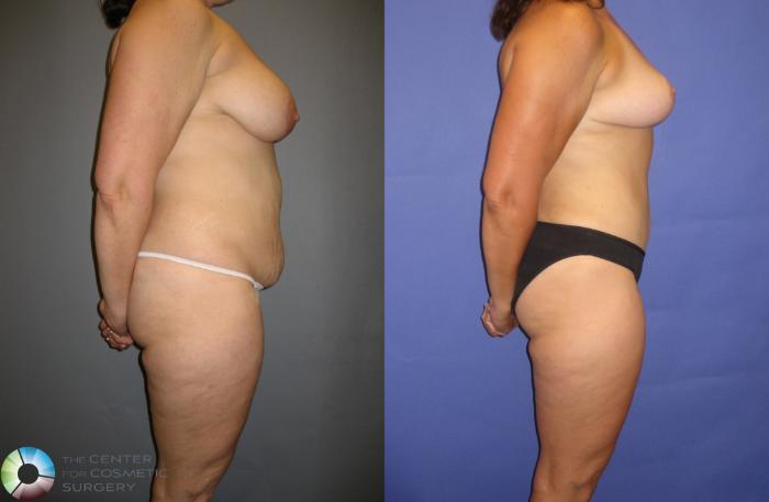 Before & After Breast Lift Case 335 View #3 in Denver, CO