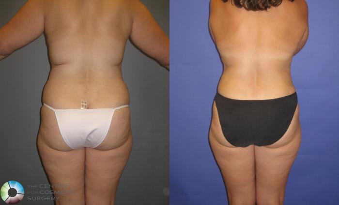 Before & After Breast Reduction Case 335 View #4 in Denver, CO