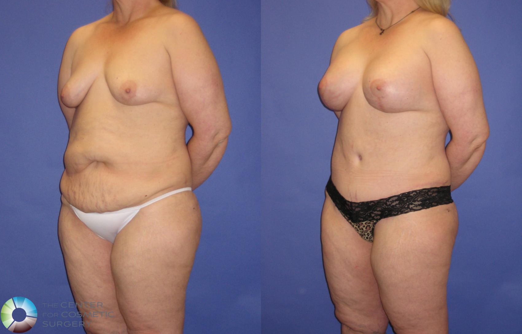 Before & After Mommy Makeover Case 341 View #1 in Denver and Colorado Springs, CO