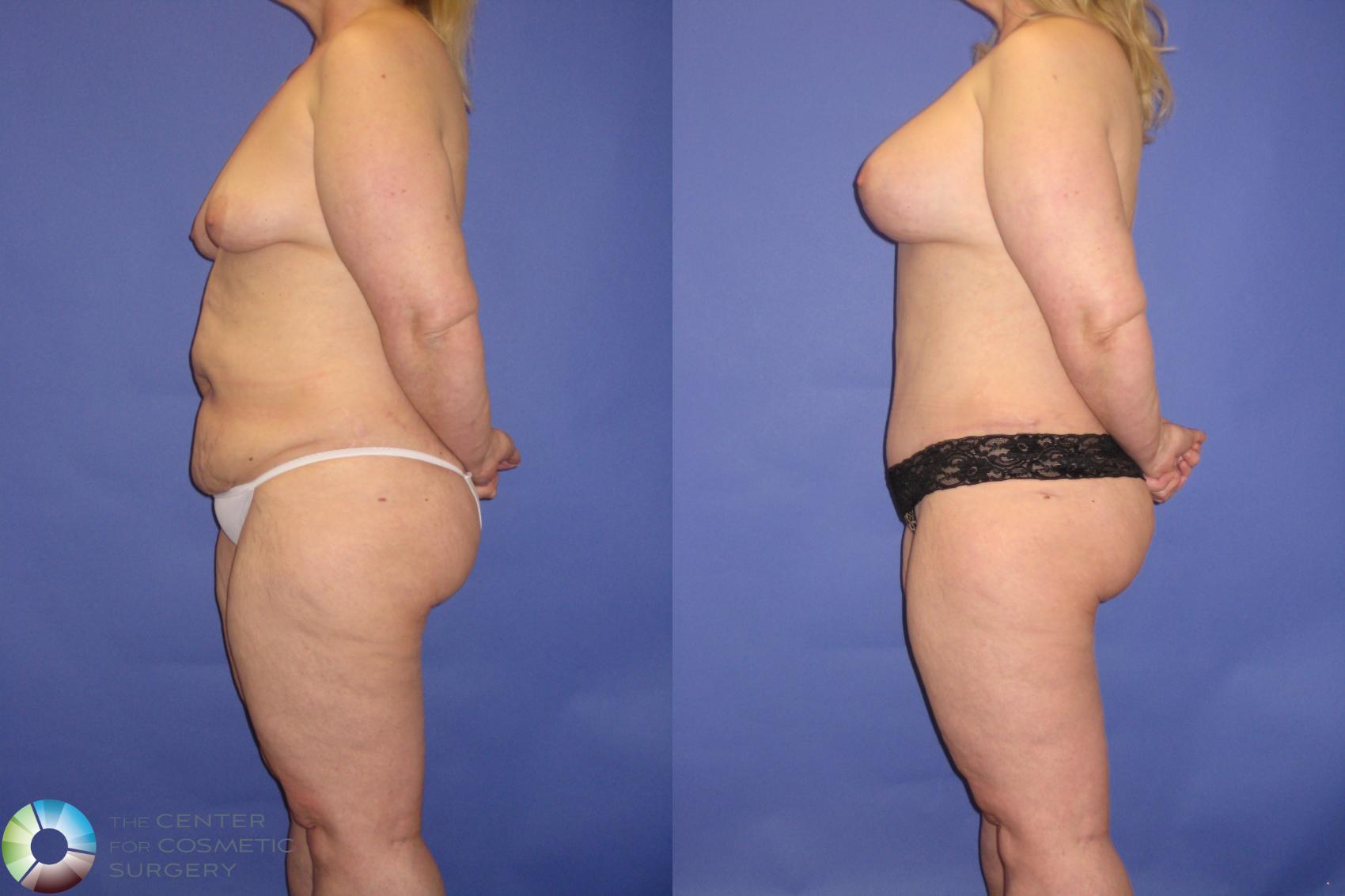 Before & After Mommy Makeover Case 341 View #2 View in Golden, CO