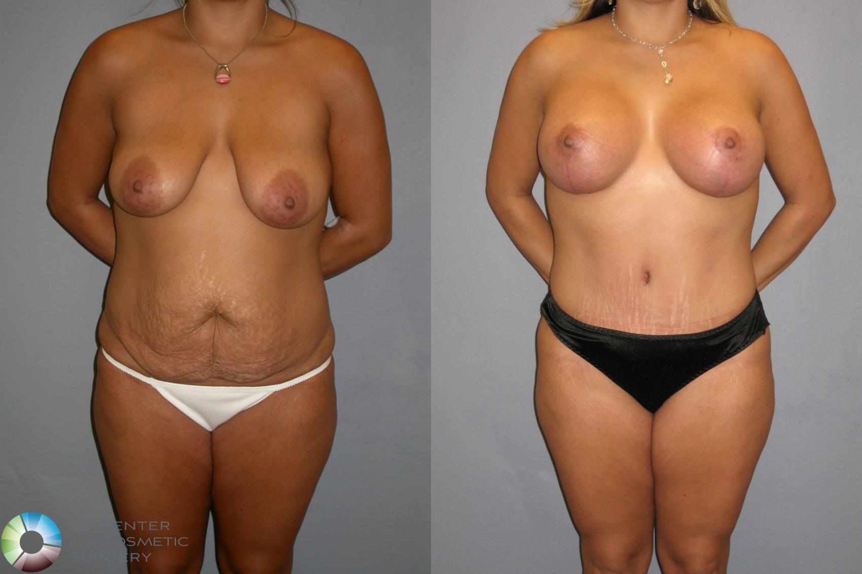 Before & After Tummy Tuck Case 346 View #2 in Denver, CO