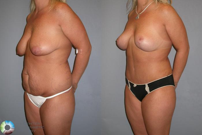 Before & After Breast Lift without Implants Case 347 View #1 in Denver and Colorado Springs, CO