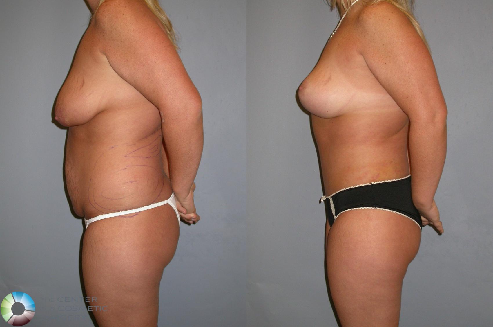 Before & After Mommy Makeover Case 347 View #2 in Denver and Colorado Springs, CO