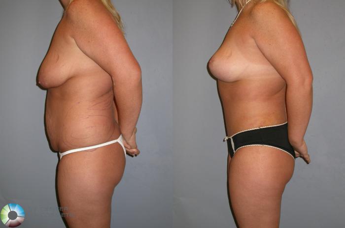Before & After Breast Lift without Implants Case 347 View #2 in Denver and Colorado Springs, CO