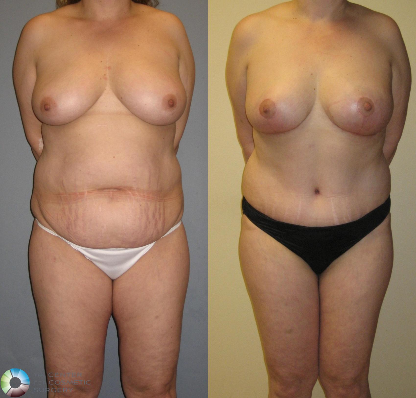 Before & After Tummy Tuck Case 349 View #1 in Denver, CO