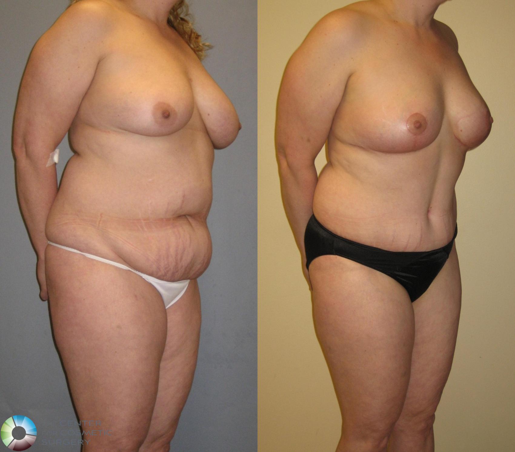 Before & After Mommy Makeover Case 349 View #2 in Denver and Colorado Springs, CO