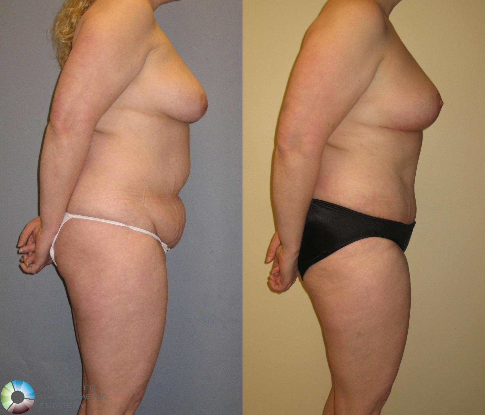 Before & After Mommy Makeover Case 349 View #3 in Denver and Colorado Springs, CO