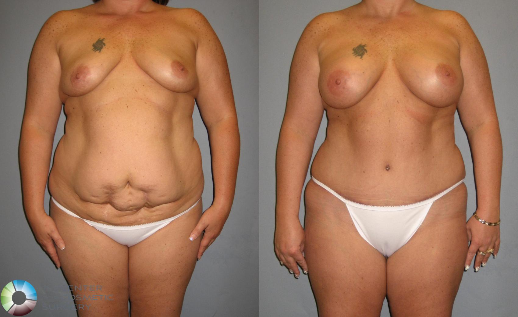 Before & After Mommy Makeover Case 354 View #1 in Denver and Colorado Springs, CO